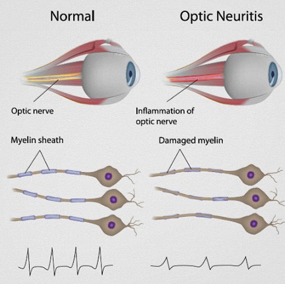 stem-cell-treatment-optic-neuropathy-stemulus