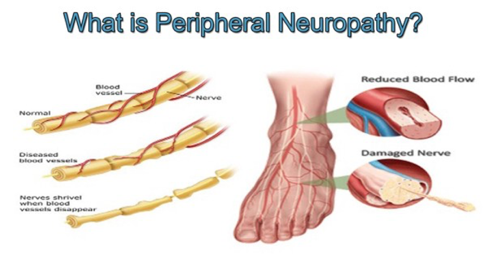 stem-cell-treatment-peripheral-neuropathy