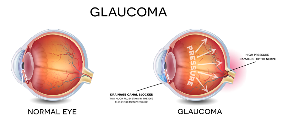 stem-cell-treatment-glaucoma-stemulus