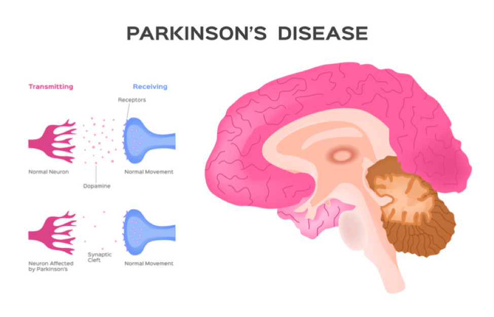 stem-cell-treatment-parkinsons-disease